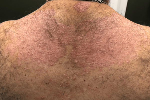 Plaque Psoriasis Case Post Treatment 2