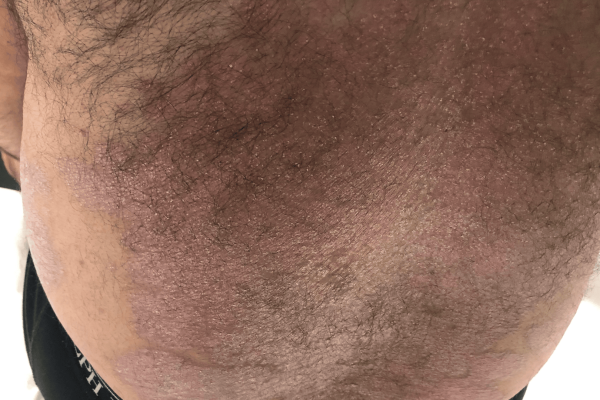 Plaque Psoriasis Case Post Treatment 4