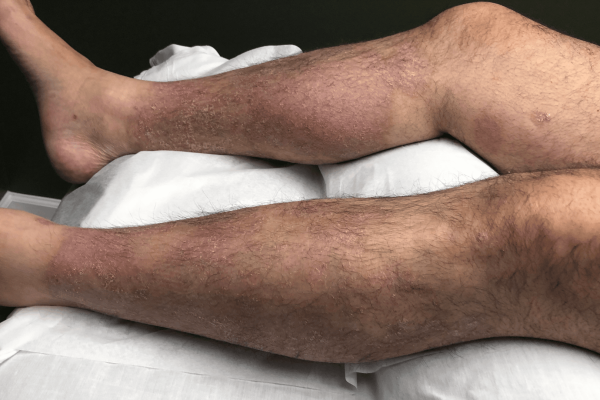 Plaque Psoriasis Case Post Treatment 5