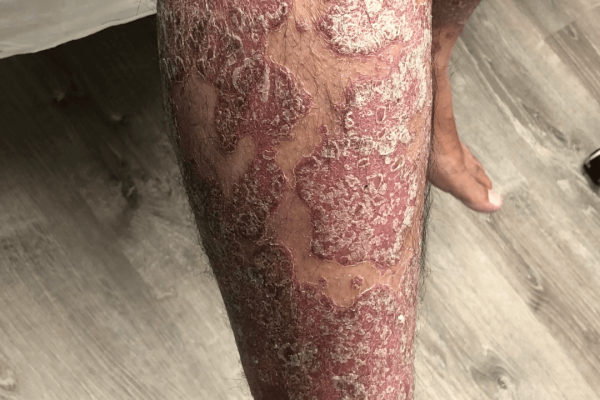 Plaque Psoriasis Case Pre Treatment 6