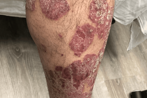 Plaque Psoriasis Case Pre Treatment 7
